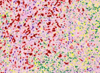 Malignant tumor area in the human body. Red glowing cells are tumor cells.