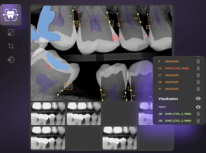Overjet-AI-Tool-for-Dentistry