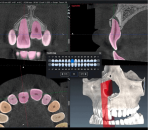 Planmeca-AI-Dental-Tool